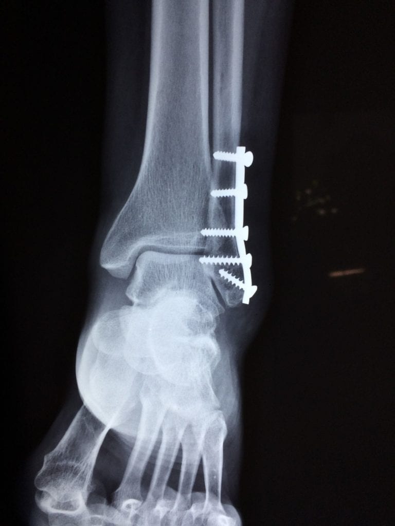 rentgen zlomený kotník
